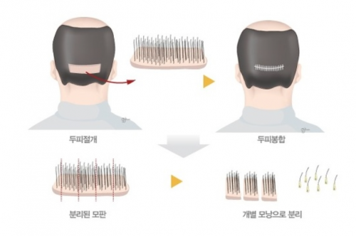 절개식